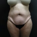 Tummy Tuck Before & After Patient #3286