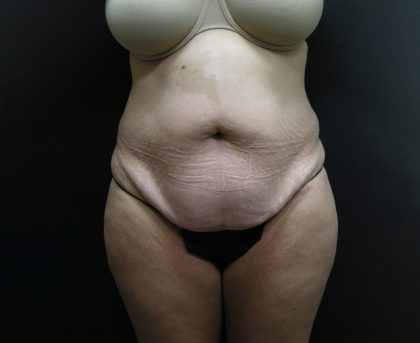 Tummy Tuck Before & After Patient #3286