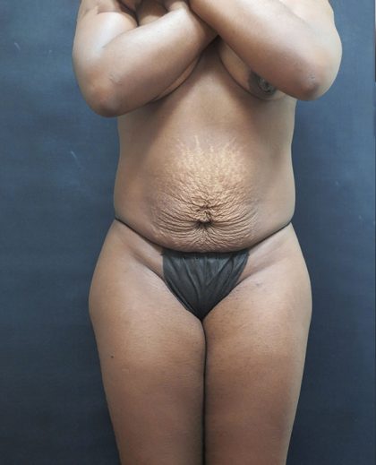 Mommy Makeover Before & After Patient #2607