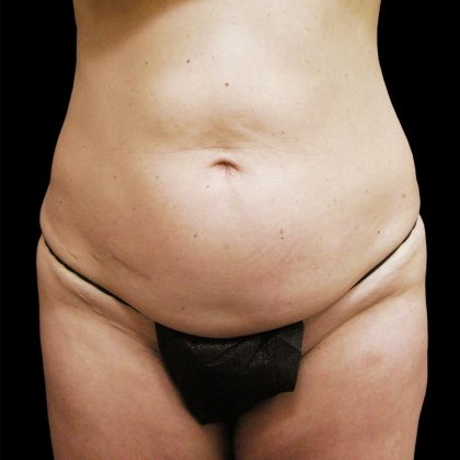Tummy Tuck Before & After Patient #3293