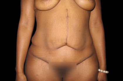 Tummy Tuck Before & After Patient #3305