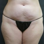 Tummy Tuck Before & After Patient #3312