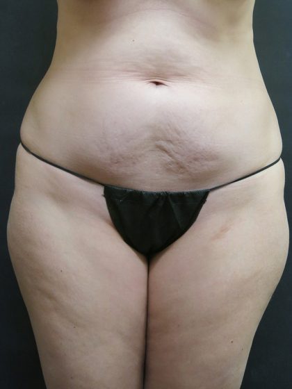 Tummy Tuck Before & After Patient #3312
