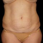 Tummy Tuck Before & After Patient #3321