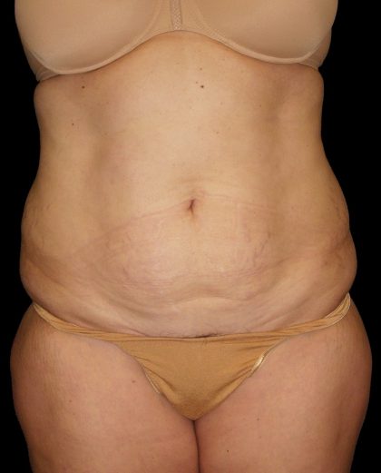 Tummy Tuck Before & After Patient #3321