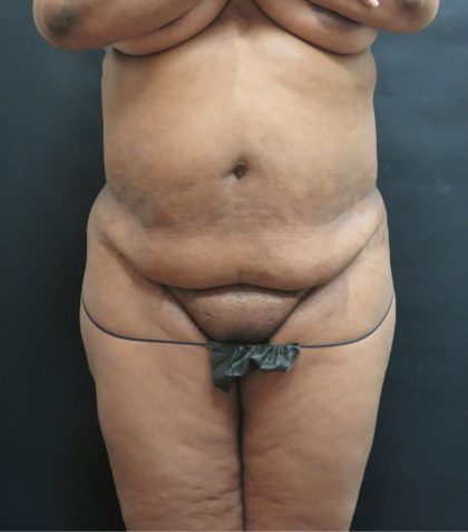 Tummy Tuck Before & After Patient #3333