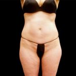 Tummy Tuck Before & After Patient #3357