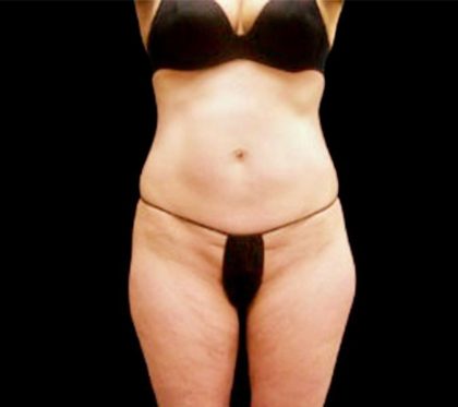 Tummy Tuck Before & After Patient #3357