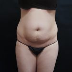 Mommy Makeover Before & After Patient #2644