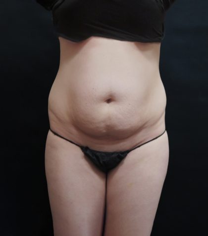 Mommy Makeover Before & After Patient #2644
