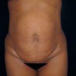 Tummy Tuck Before & After Patient #3366
