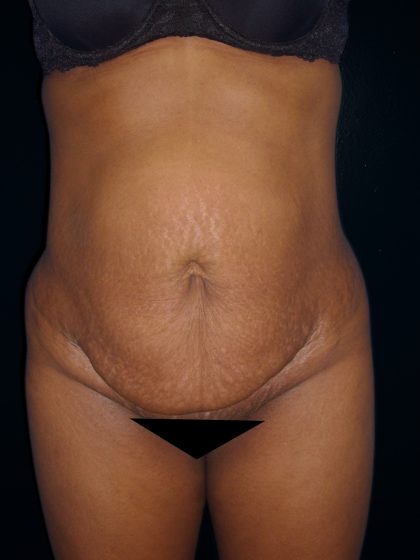 Tummy Tuck Before & After Patient #3366