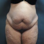 Tummy Tuck Before & After Patient #3380
