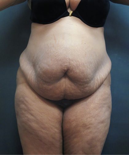 Tummy Tuck Before & After Patient #3380