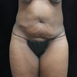 Tummy Tuck Before & After Patient #3387
