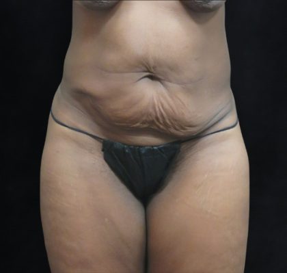 Tummy Tuck Before & After Patient #3387