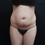 Tummy Tuck Before & After Patient #3396