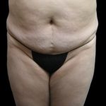 Tummy Tuck Before & After Patient #3403