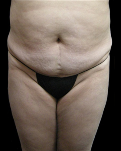 Tummy Tuck Before & After Patient #3403
