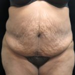 Tummy Tuck Before & After Patient #3412