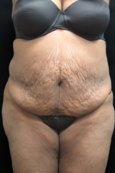 Tummy Tuck Before & After Patient #3412