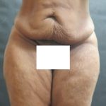 Tummy Tuck Before & After Patient #3419