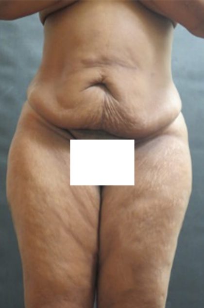 Tummy Tuck Before & After Patient #3419