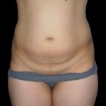 Tummy Tuck Before & After Patient #3426