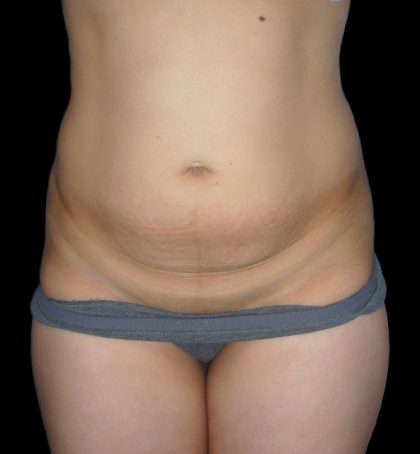 Tummy Tuck Before & After Patient #3426