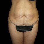 Tummy Tuck Before & After Patient #3433