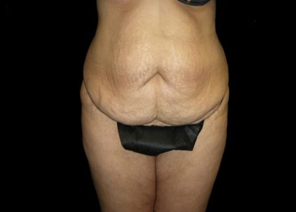 Tummy Tuck Before & After Patient #3433