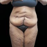 Tummy Tuck Before & After Patient #3352