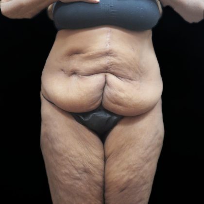 Tummy Tuck Before & After Patient #3352