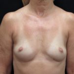 Breast Augmentation Before & After Patient #1129