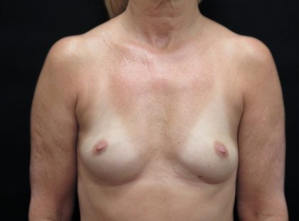 Breast Augmentation Before & After Patient #1129