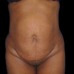 Mommy Makeover Before & After Patient #2442