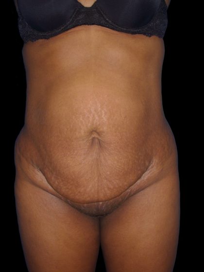 Mommy Makeover Before & After Patient #2442