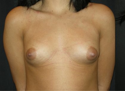 Breast Augmentation Before & After Patient #1091