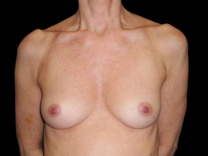 Breast Augmentation Before & After Patient #1005