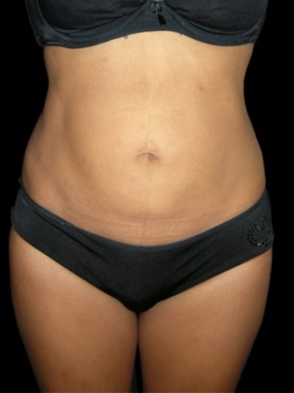 Mommy Makeover Before & After Patient #2396
