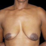 Breast Augmentation Before & After Patient #1098