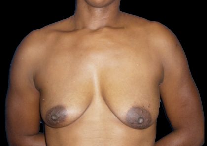 Breast Augmentation Before & After Patient #1098