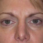 Browlift Before & After Patient #1482