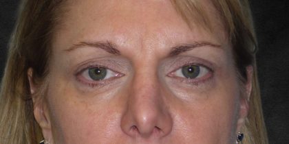 Browlift Before & After Patient #1482