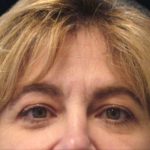 Browlift Before & After Patient #1479