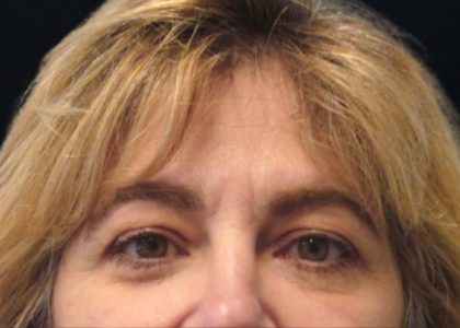 Browlift Before & After Patient #1479