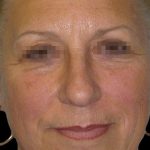 Browlift Before & After Patient #1466