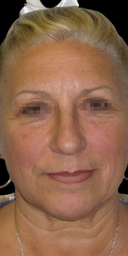 Browlift Before & After Patient #1466