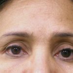 Browlift Before & After Patient #1476