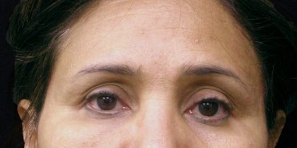 Browlift Before & After Patient #1476
